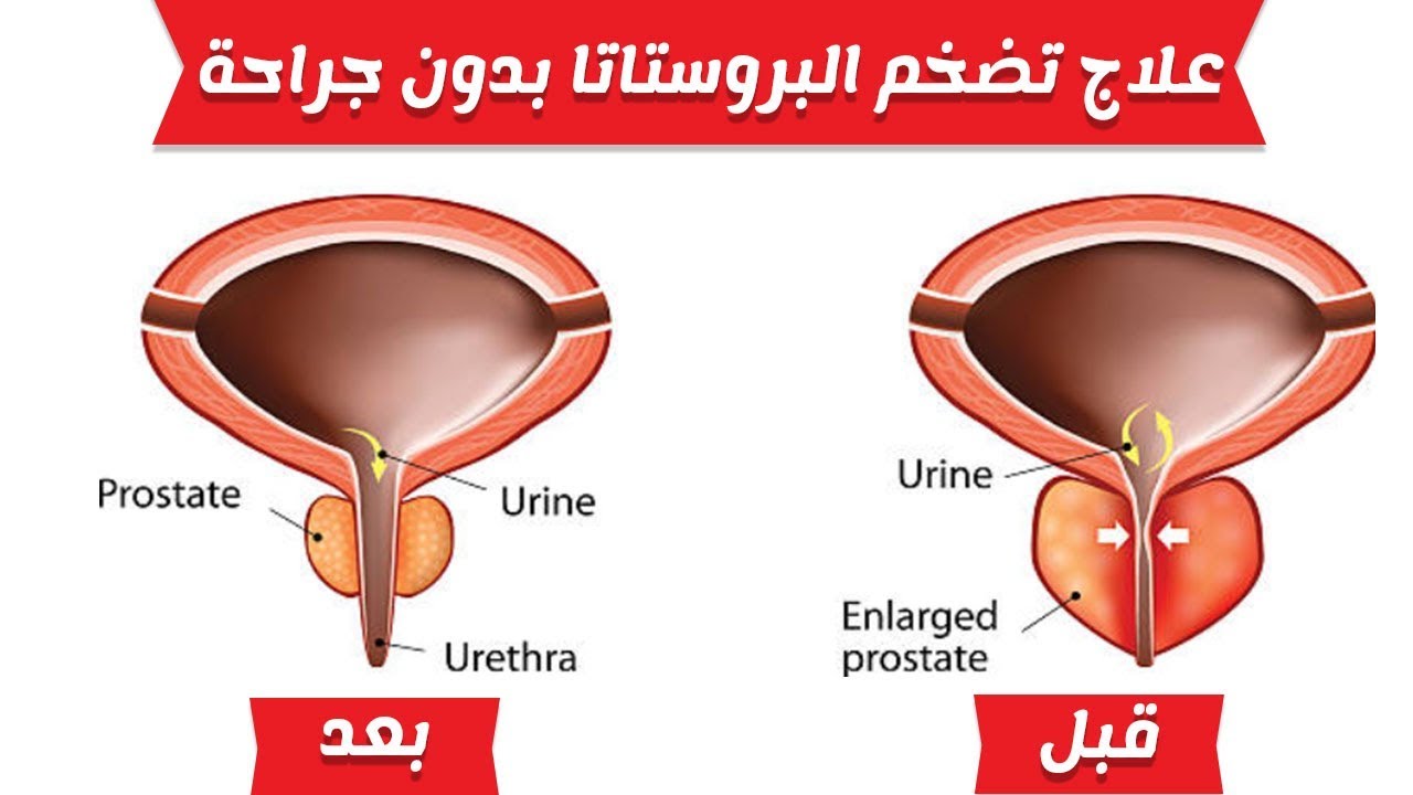 علاج البروستاتا 4705 1