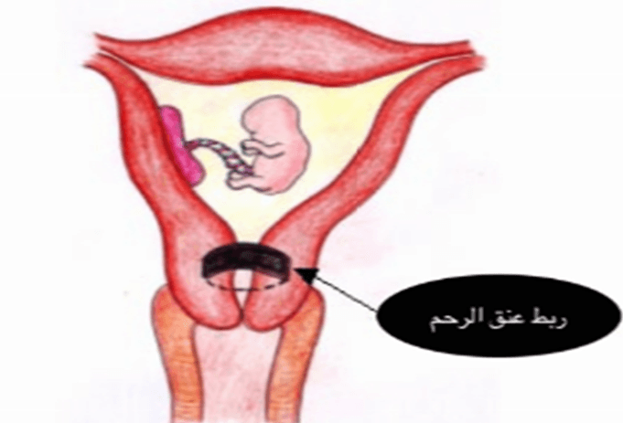 ربط عنق الرحم والجماع , تعرف على عملية ربط عنق الرحم وعلامتها