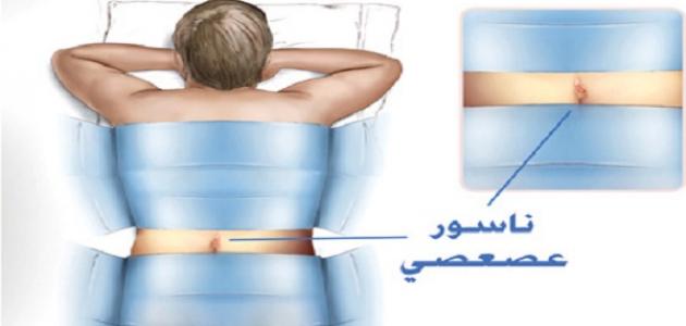 علاج الناسور , تعريف الناسور وعلاجه