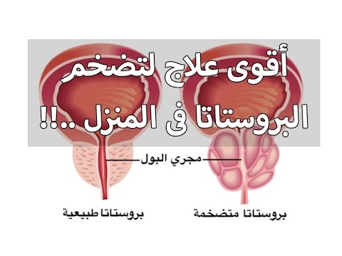 علاج تضخم البروستاتا - ادوية للعلاج تضخم البروستاتا 3053