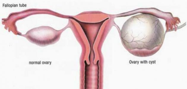ماهي اعراض تكيس المبايض - اهم اعراض و ظواهر مرض تكيس المبايض 1407 2