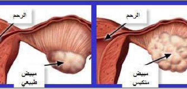 اعراض تكيس المبايض - اهم اعراض و مظاهر تكيس المبايض 1200 1