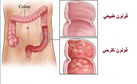 اعراض التهاب القولون - اهم ظواهر التهابات القولون 1608