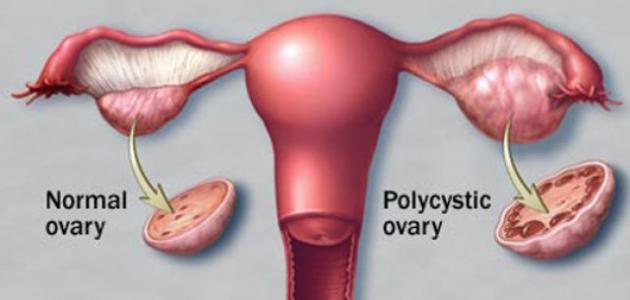 اعراض تكيس المبايض - اهم اعراض و مظاهر تكيس المبايض 1200
