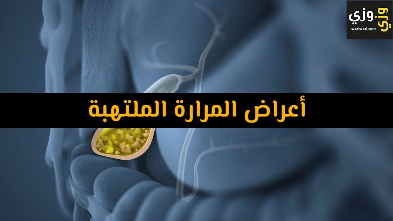 اعراض المرارة، أسباب التهاب المراره 3604 1