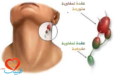 لازم تذهب الى الطبيب مباشرة - الم الحنجرة عند البلع 12347 2