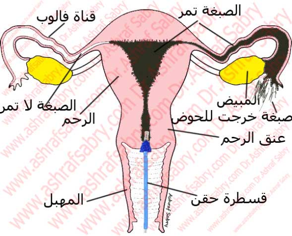 اشعة الصبغة على الرحم بالتخدير - نتائج اشعة بالصبغة 12815