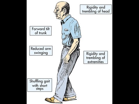مرض باركنسون - تعريف مرض باركنسون 121 1