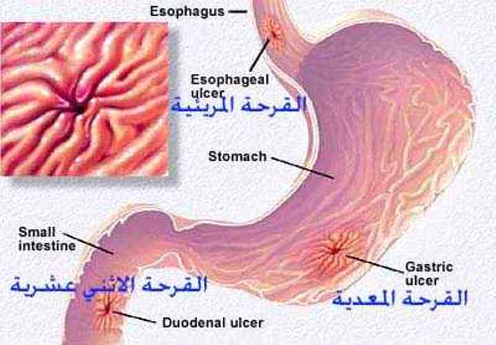 اعراض قرحة المعدة والقولون - تعرف على الام قرح المعدة وكيفية الوقاية منها 12376