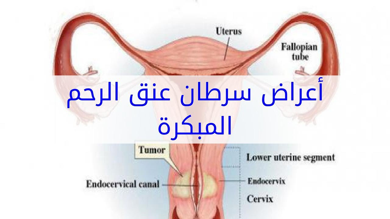 اعراض سرطان الرحم - اسباب سرطان الرحم 3237 3