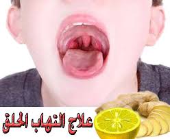 اعراض التهاب الحلق