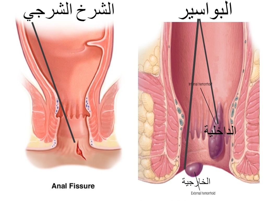 اعراض البواسير , فيديو توضيحي لاعراض البواسير