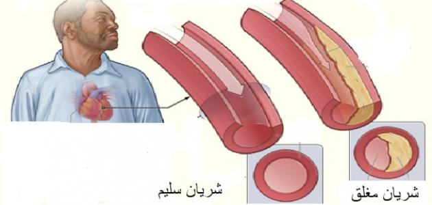 علاج مرض القلب - كيفية التخلص من امراض القلب 1491