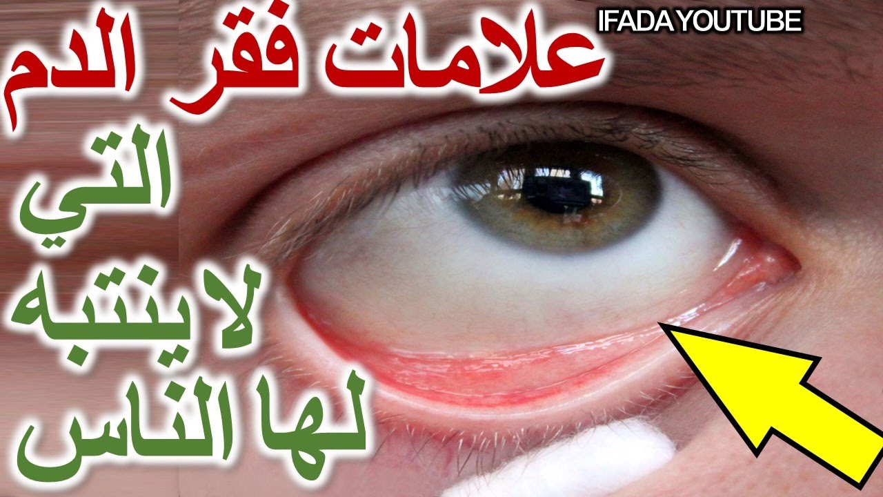 اعراض فقر الدم - ما هو مرض فقر الدم 548 1