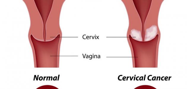 اعراض سرطان الرحم - اسباب سرطان الرحم 3237 6