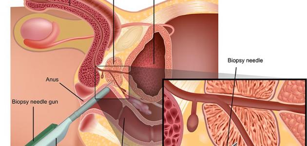 اسباب تضخم البروستاتا - تعريف البروستات 76 1