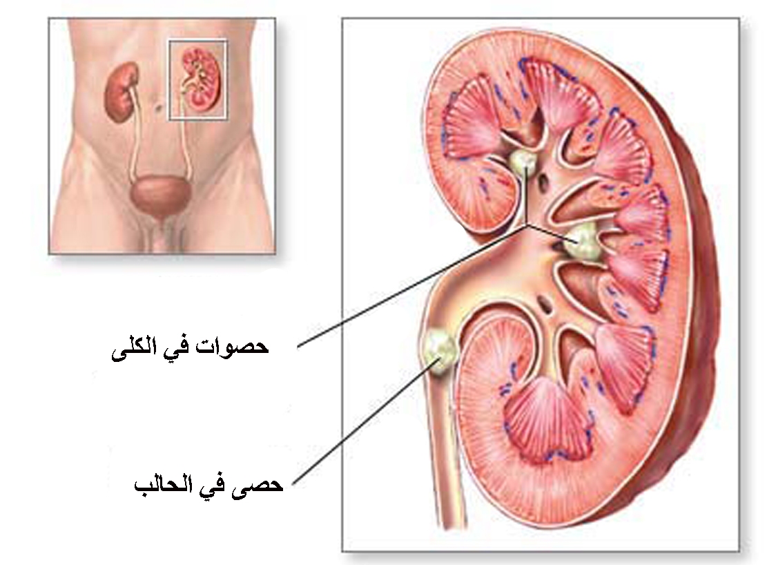 امراض الكلى واعراضها - انواع امراض الكلي 12390 2