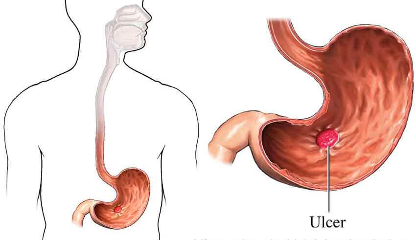 اعراض قرحة المعدة , كيف تعرف انك مصاب بقرحة المعدة