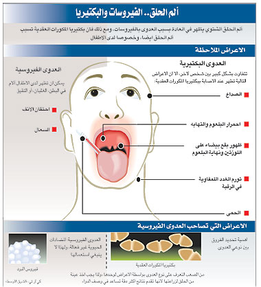 لازم تذهب الى الطبيب مباشرة - الم الحنجرة عند البلع 12347 1