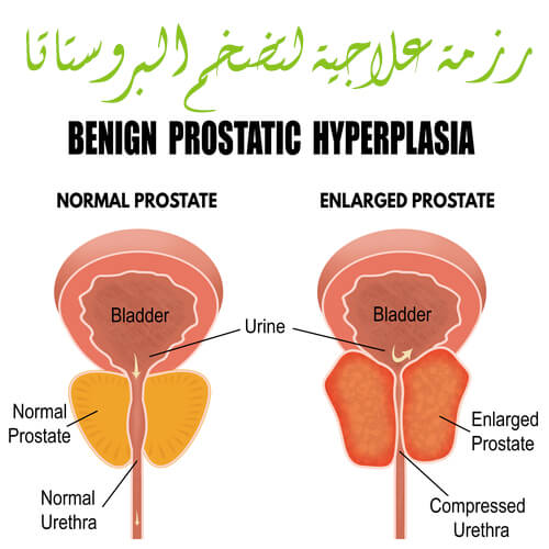 علاج تضخم البروستاتا - ادوية للعلاج تضخم البروستاتا 3053 1