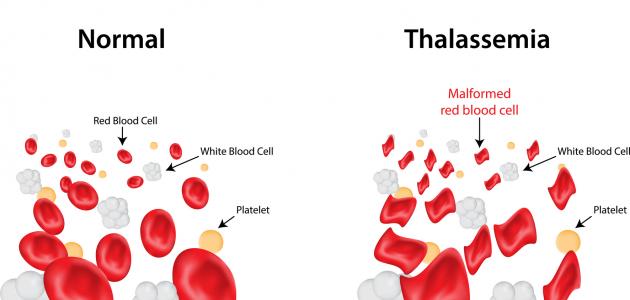 مرض الثلاسيميا - ماهو مرض الثلاسيميا 2816 3