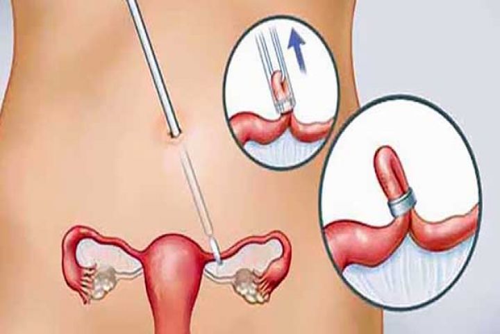 اضرار عملية ربط عنق الرحم , ربط عنق الرحم والجماع