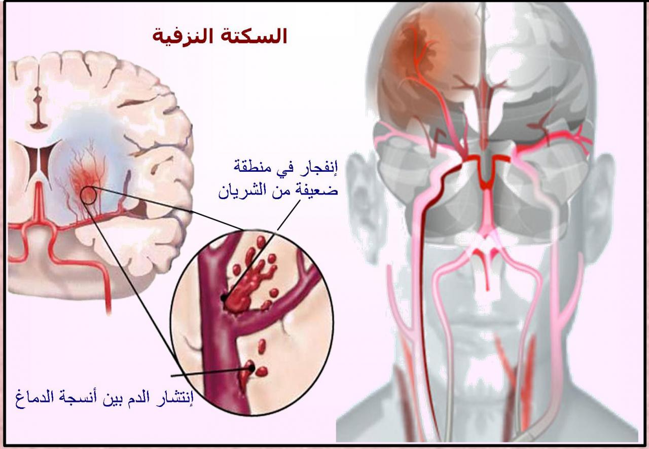 اعراضه شبه حاجات تانية - اعراض نزيف المخ 12028 2