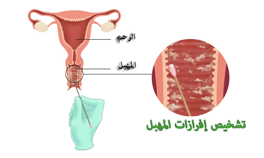 خروج رائحة كريهة من المهبل - التخلص من رائحة المهبل 12818