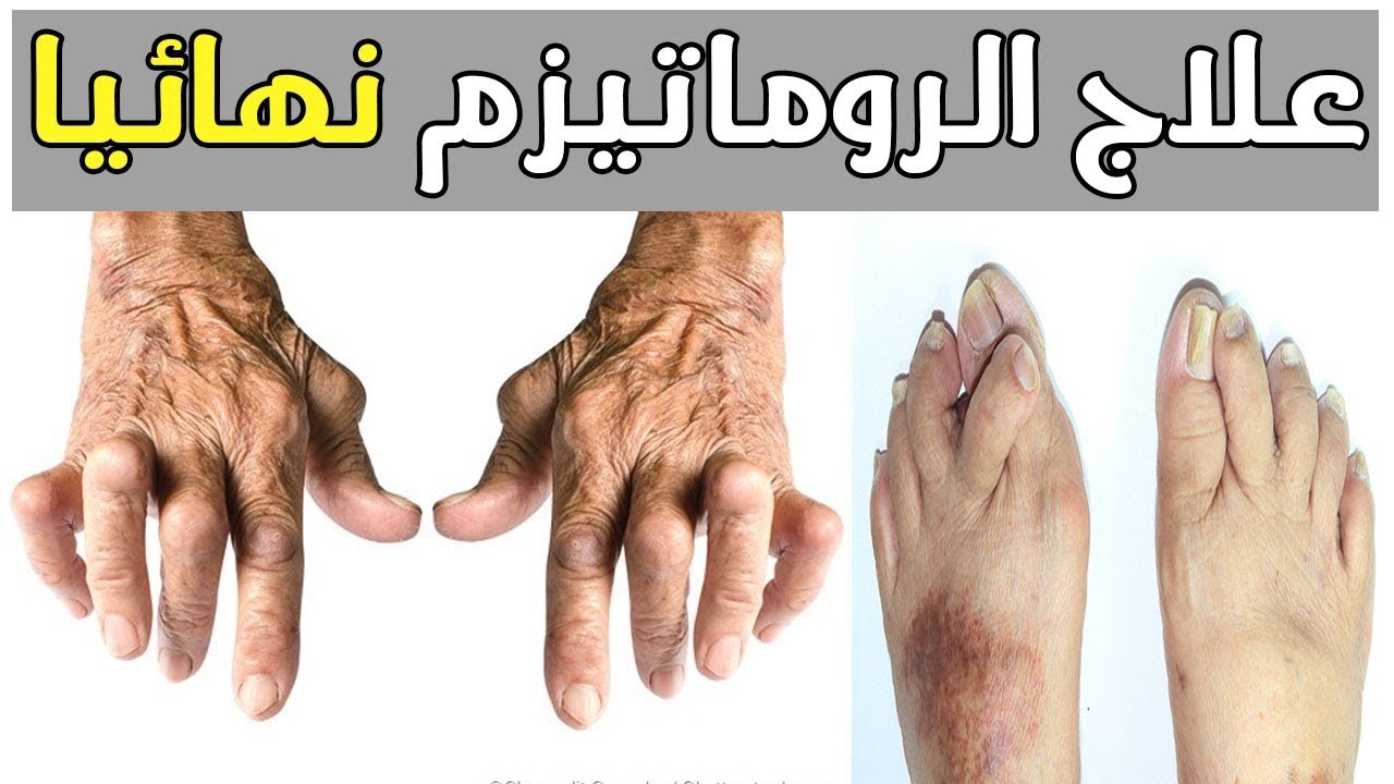 اعراض الروماتيزم , التخلص من الروماتيزم