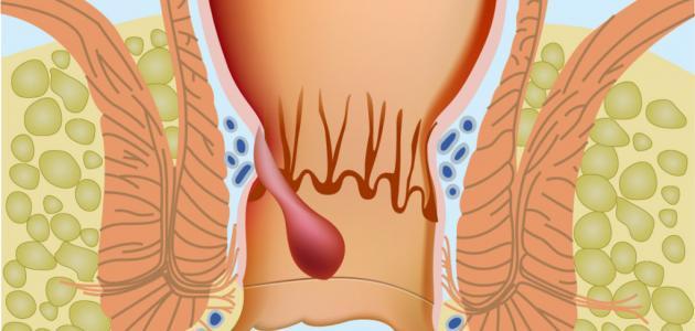 مرض البواسير،معقول دي اعراض البواسير 5697 3