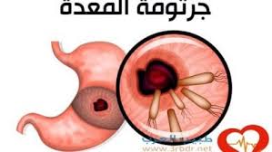 اكلات تقتل جرثومة المعده , فعالة بنتيجة سريعة